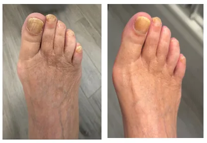 Before and after one treatment.